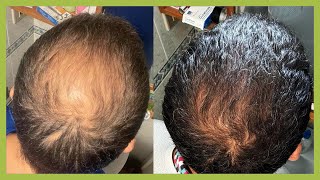 RECUPERA su CABELLO en 5 MESES SIN TRASPLANTE CAPILAR