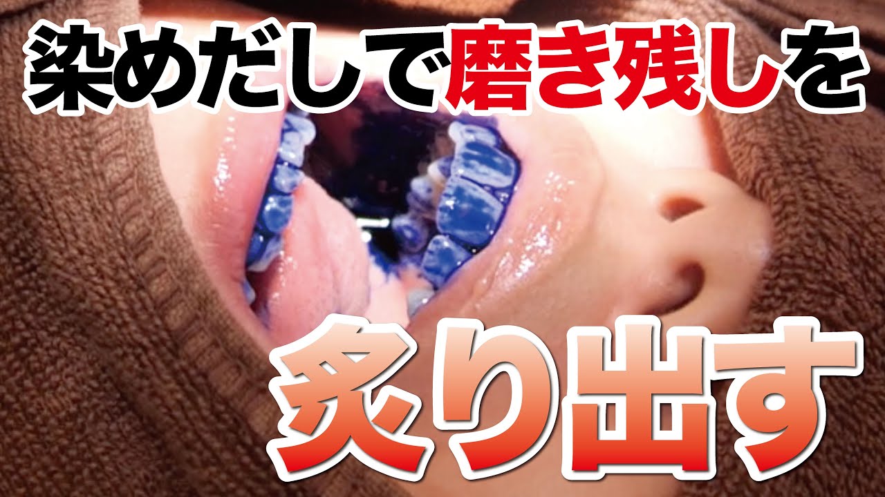 磨き残しを徹底炙り出す！知りたい歯磨きのコツをプロの歯科衛生士が教えます！