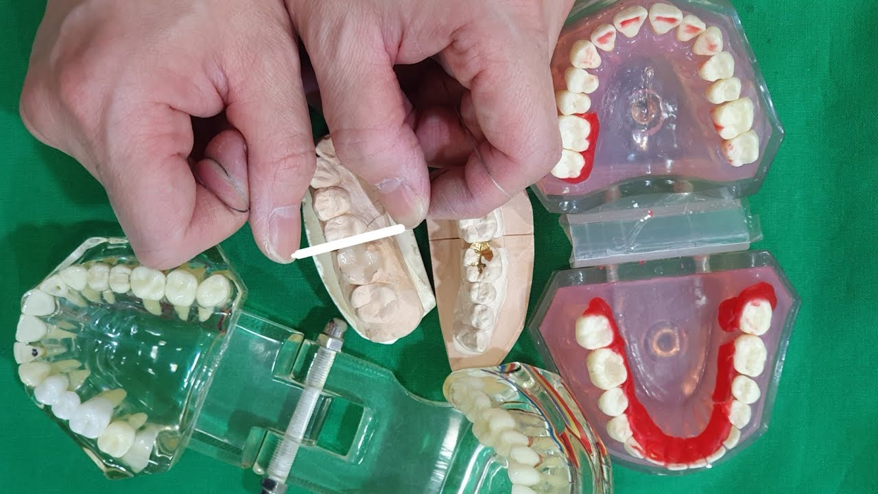 치실 쓰고 망하는 경우 (30만원 날림)