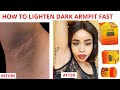 Watch How i Lighten And Get Rid Of My Dark Armpit Fast with Carotone