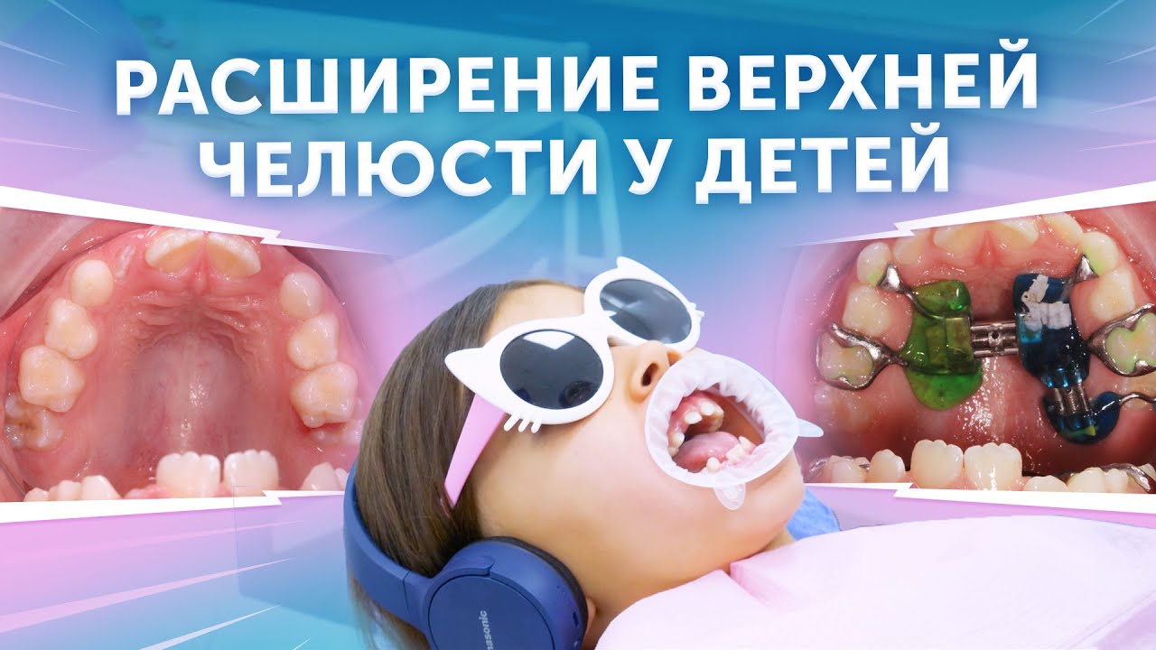 Расширение верхней челюсти у детей | Аппарат Haas
