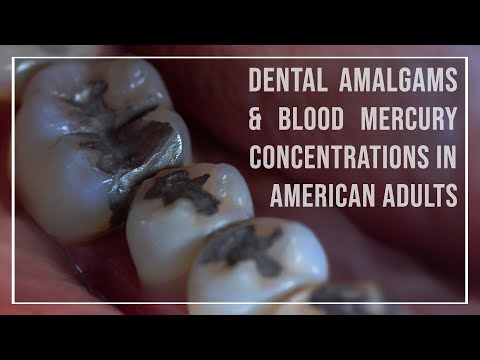 Mercury Dental Fillings Raise Blood Mercury to Dangerous Levels in 100+ Million Americans