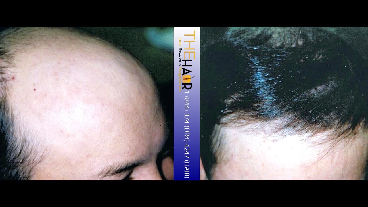Toronto Medical Hair Loss Recovery YouTube