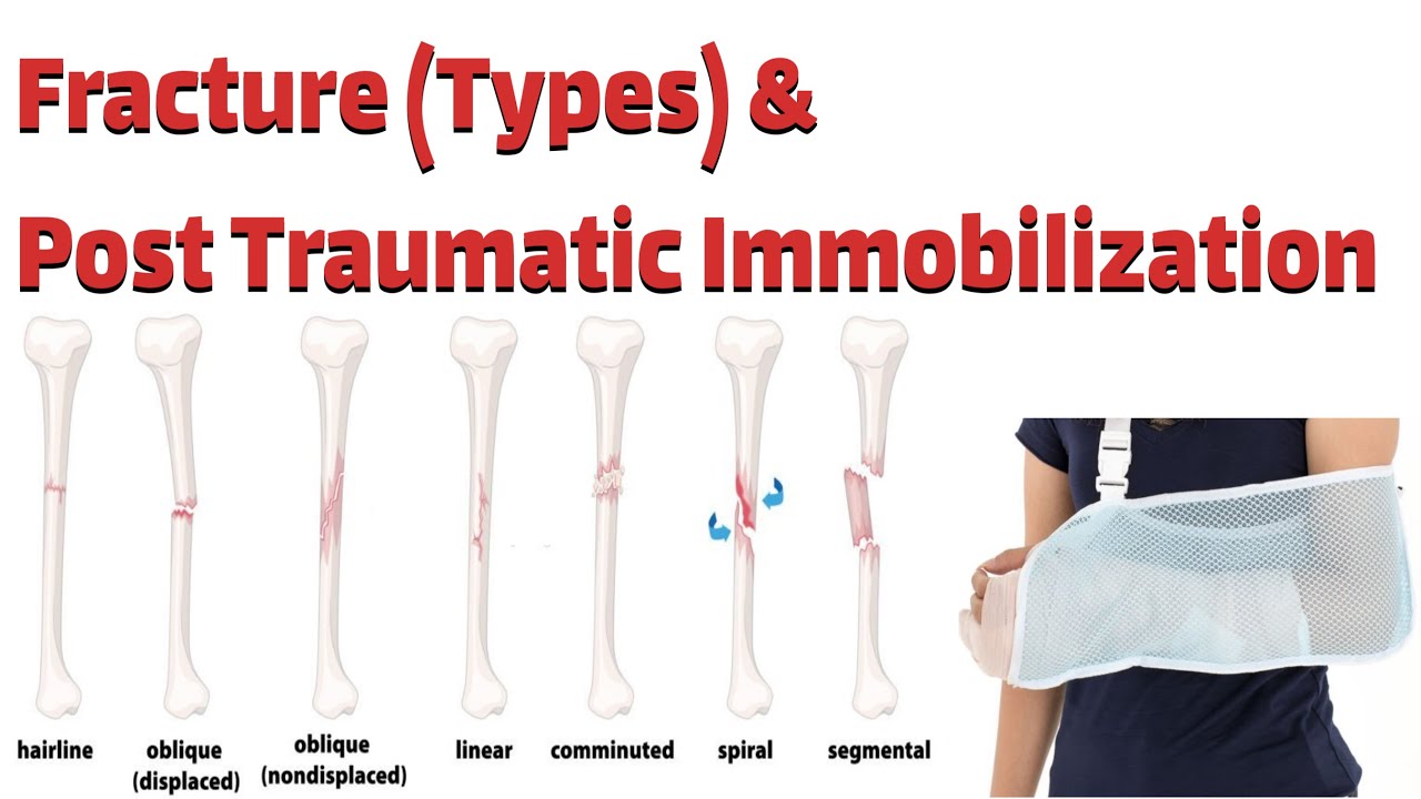 Fracture Types Post Traumatic Immobilization YouTube Fracture Types Post Traumatic Immobilization YouTube