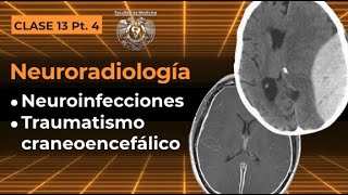 13.4 -  Neuroradiología: Neuroinfecciones y Traumatismo Craneoencefálico