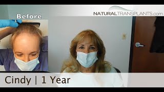 Hair Transplantation Clinics | Hair Replacement Center for Women | Natural Hair Transplants