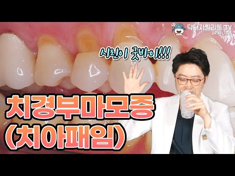   치경부마모증 치아패임 레진 Gi 치료로 시린이 굿바이 보험 비용