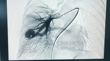 ĐIỀU TRỊ NÚT DỊ DẠNG ĐỘNG TĨNH MẠCH PHỔI (PAVM: PULMONARY ARTERIOVENOUS MALFORMATION)