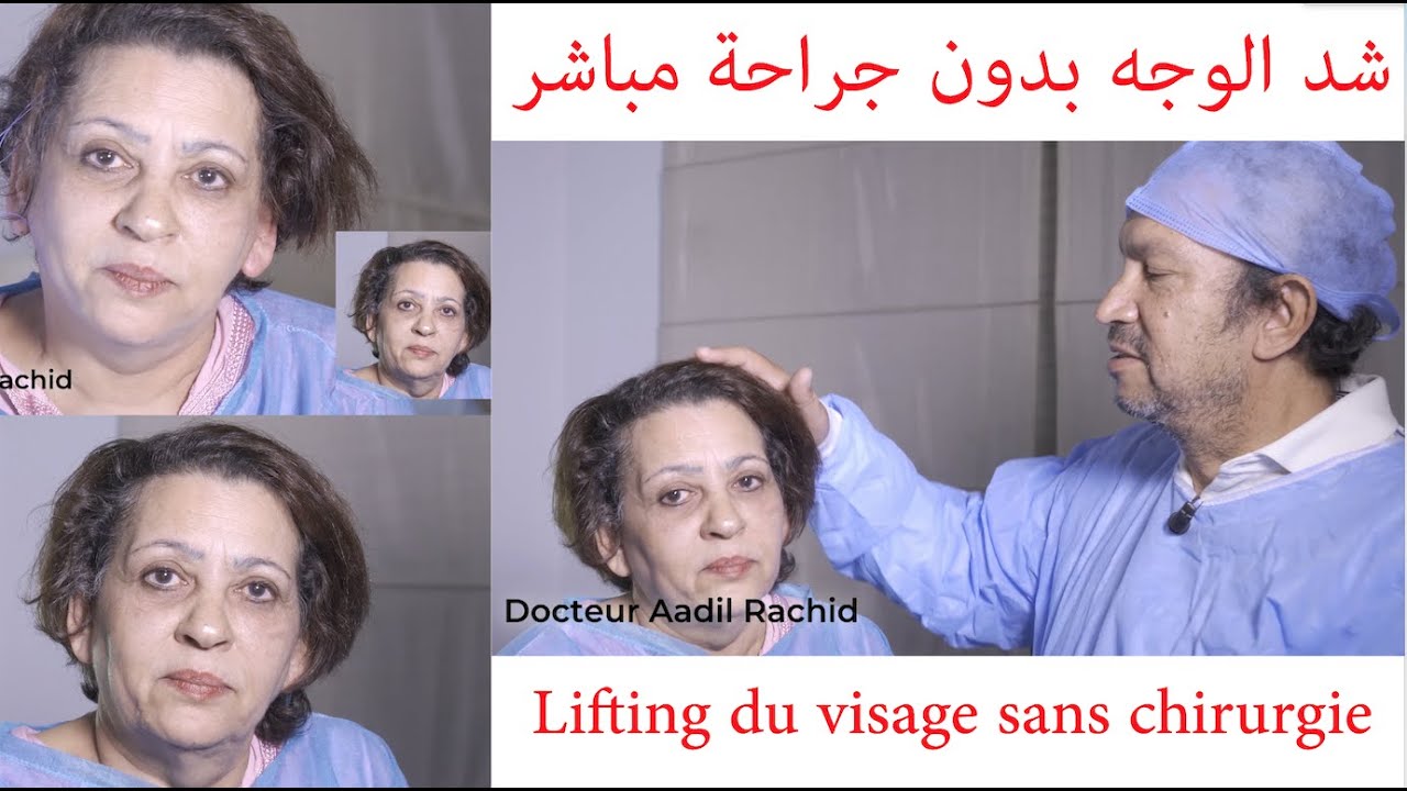 شد الوجه بدون جراحة مباش -les fils lifteurs du docteur aadil rachid
