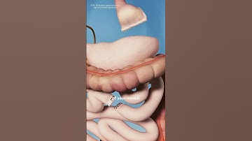 Gastric Bypass Surgery (3D animation) #drone #theflash #space #automobile
