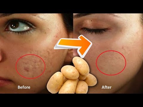 In  DAYS - Remove DARK SPOTS, BLACK SPOTS & ACNE SCARS || Gold Star Entertainment