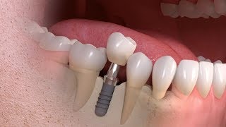 Zahnimplantat Kosten und Zahnersatz aus dem Ausland