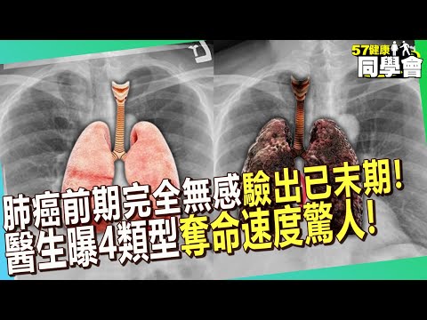 肺癌前期完全無感「咳不停驗出已末期」！醫生曝4類型「惡化快、奪命速度驚人」屬癌症王中王【 @57healthy 】#陳榮堅 醫師