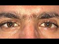 3d artificial eye made by ocularist ravikant sharma at suvidha eye service