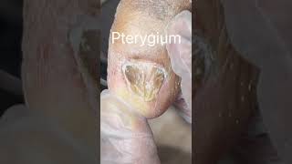 Pterygium of the Toenail