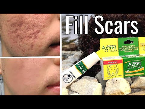 Get Rid Of Acne & Acne Scar(Gadde Aur Dagh), Acnes Scar Care Gel Review Urdu Hindi