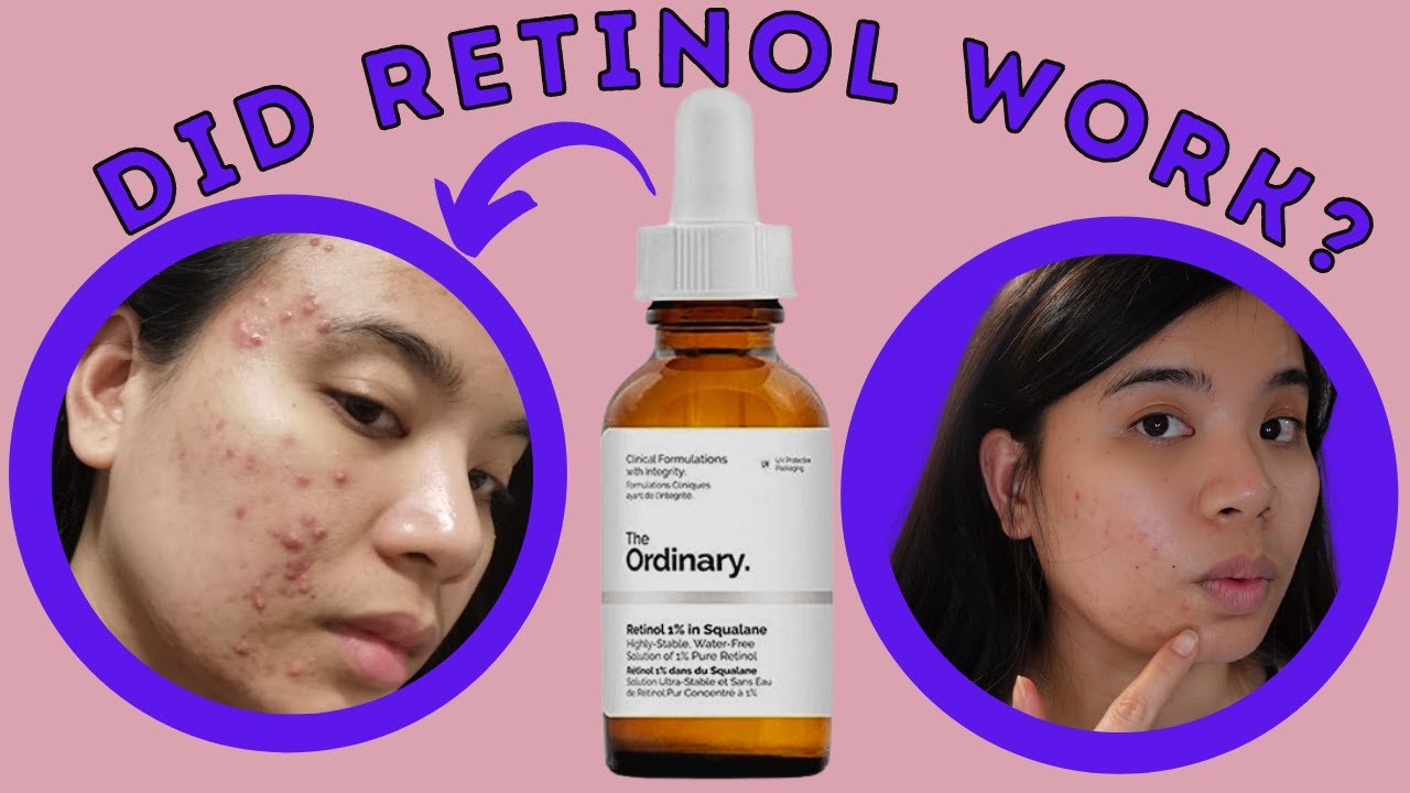 The Ordinary Retinol 1% quick review on ACNE | weeks update | Pre-birthday vlog | Struggles - YouTube