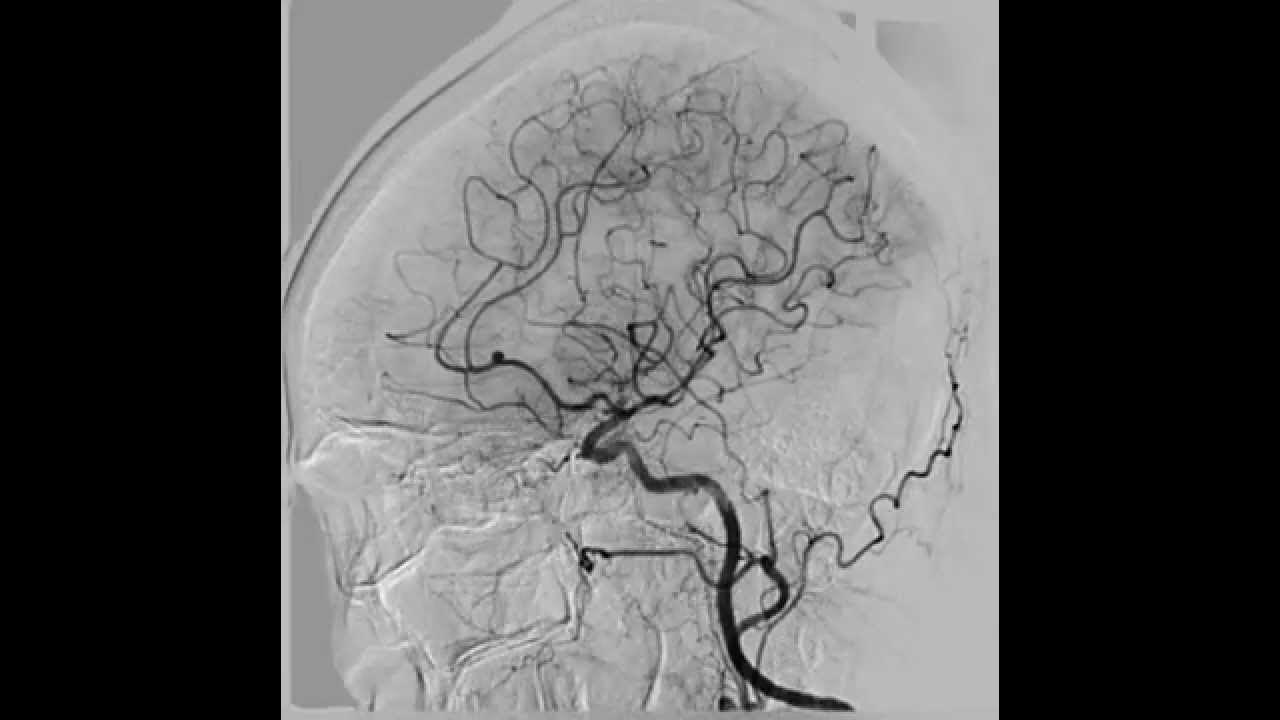 Сегмент а1 пма. Аневризма в переднемозговой артерии. Мешковидная аневризма головного мозга. Эмболизация аневризмы ВСА. Аневризма передней мозговой артерии головного мозга.