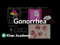 Understanding Gonorrhea: Causes, Diagnosis, and Prevention