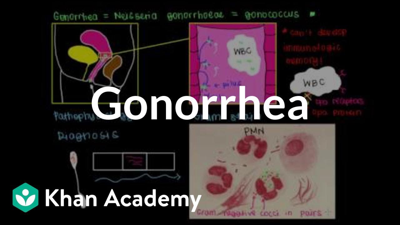 gonorrhea okozhat fogyni