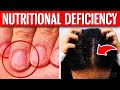 12 ALARMING Signs That Indicate You Have A Nutritional Deficiency