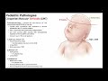 Torticollis → Mechanism, Pathophysiology, &amp; Effects in Infants