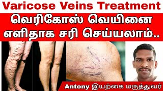 Varicose Veins | வெரிகோஸ் வெயின் குணமாக இதை மட்டும் தடவி வந்தால் போதும் @Sadhgurusaicreations