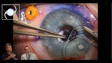 Sutured Intraocular Lens for Patient with Dislocated IOL