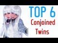 Top Six Conjoined Twin Pairs in History