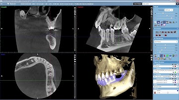 Overlaying an STL File with a CBCT Volume