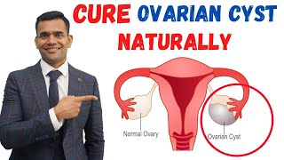 Just 3 Recommendations To Cure Ovarian Cyst Naturally - Dr. Vivek Joshi screenshot 1