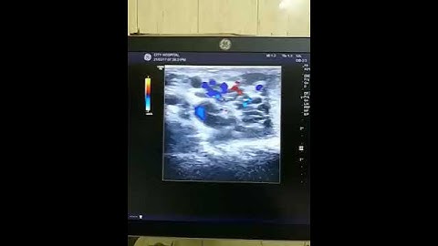 Varicocele on valsalva maneuver