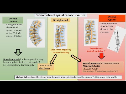 Degenerative Cervical Spine Management || หลักการเลือกวิธีผ่าตัดกระดูกคอเสื่อม