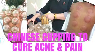 BLACK GIRL GETS CHINESE CUPPING 😳 || HOW TO CURE ACNE|| QUICK BACK PAIN RELIEF