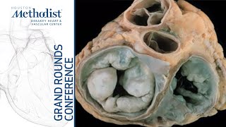 The Future of Structural Heart Interventions: TMVR and Beyond (Juan F. Granada, MD) January 21, 2021