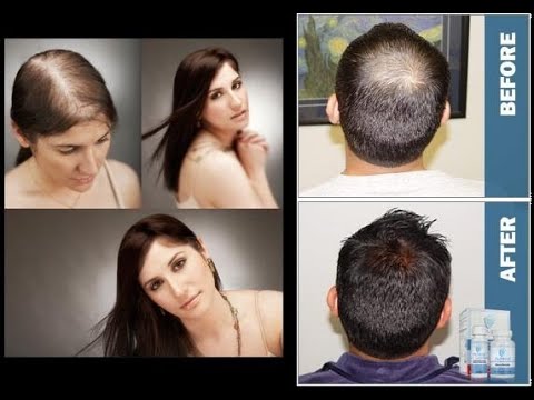 provillus-:-best-treatment-to-hair-loss-for-men-&-women-review