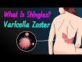 What is Varicella Zoster(Shingles)?