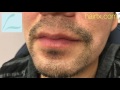 Dallas Beard/Goatee/Moustache Hair Transplant HD Close-Up Result