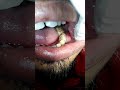 Buccal space infection. Dr Prabhuraj Sabarad, MDS