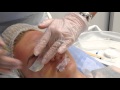 Меди Лайт 2 Процедура желтый пилинг на основе ретиноевой кислоты с применением мезороллера ЛИЦО