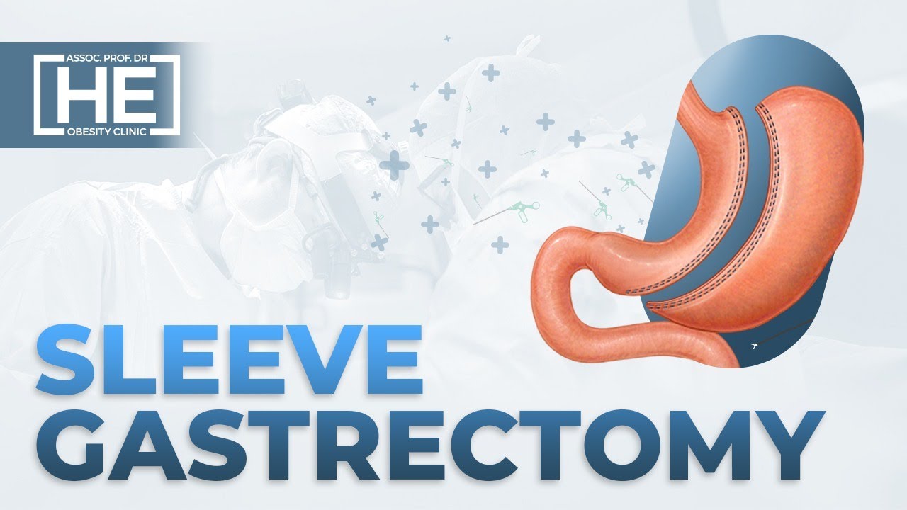 Gastric Sleeve Turkey Laparoscopic Sleeve Gastrectomy Animation