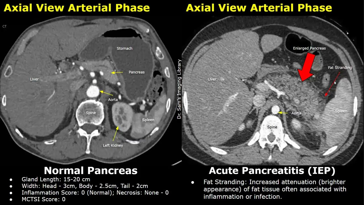 CT Normal Pancreas Vs Acute Pancreatitis | Balthazar Modified CT Severity Index (MCTSI) Scoring