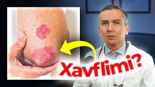 Tirsakdagi yaralar xavflimi? Psoriaz kasalligi haqida!