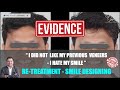 Poorly Done Dental Veneers Redone | Re-Treatment Smile Designing | Dental Capping | Dental Crown