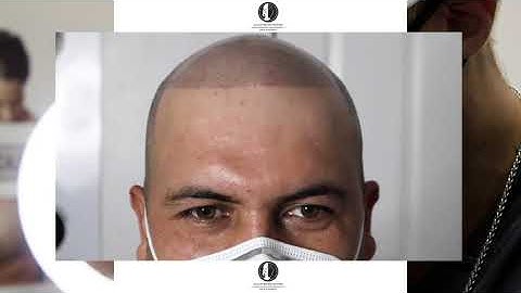 Scalp Micropigmentation 3rd session | Scalp Micro Nation Orange County