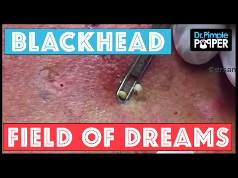 Blackhead Field of Dreams: Supercomedones & Dilated Pores of Winer