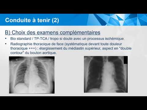 Vidéo: Dissection Aortique - Causes, Types Et Symptômes De Dissection Aortique, Traitement