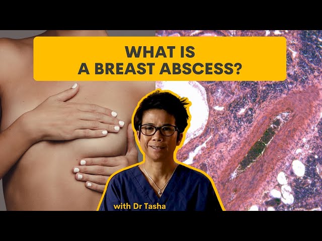 Breast Abscess - Signs and Symptoms - with Dr Tasha 