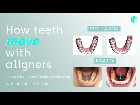 How teeth move with aligners - now explained