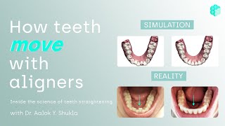 How teeth move with aligners - now explained